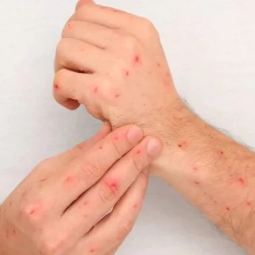 Ecuador detecta el primer caso de la variante clado Ib de la mpox