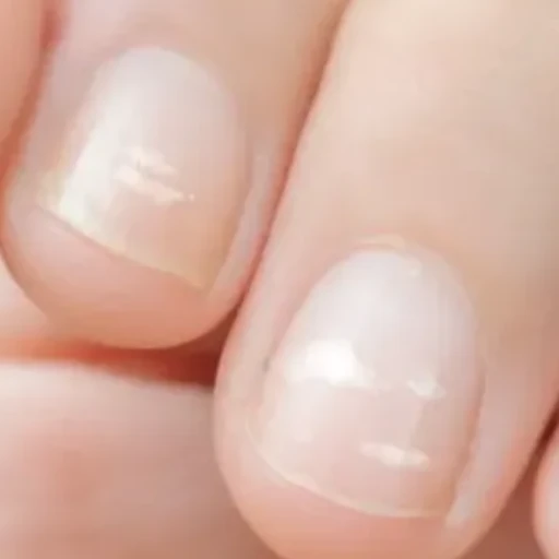¿Por qué aparecen las manchas blancas en las uñas? La leuconiquia es el nombre con el que se conocen